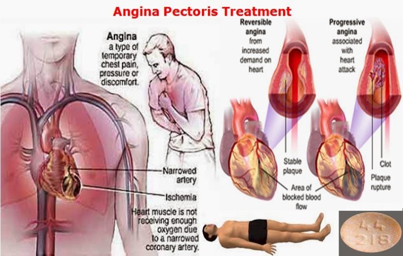 Angina Chest Pain & Tightness, Symptoms, Types & Treatment