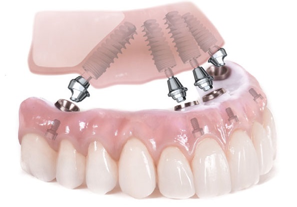 ALL- ON- 4 dental implants are one of the highly recommended alternatives to dentures