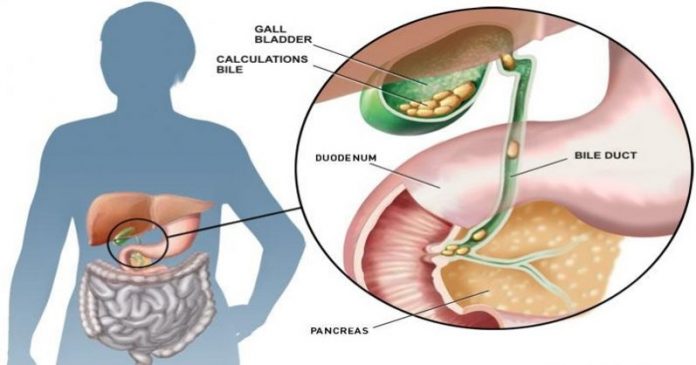 GALL BLADDER STONES – ETIOLOGY, SYMPTOMS AND TREATMENT