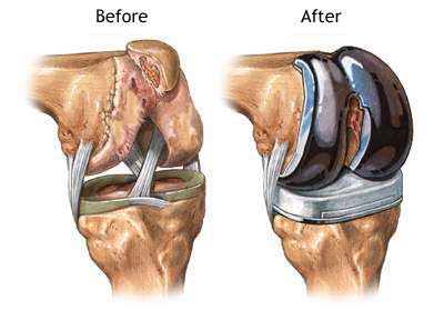 Total Knee Replacement: Surgery Pain, Recovery & Risks
