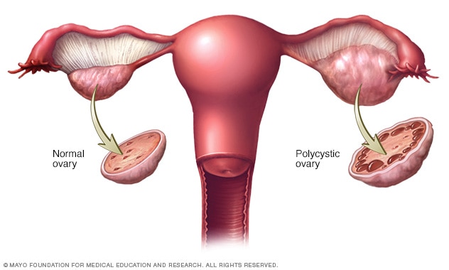 Polycystic ovarian syndrome (PCOS) is a common endocrine and reproductive system disorder among women