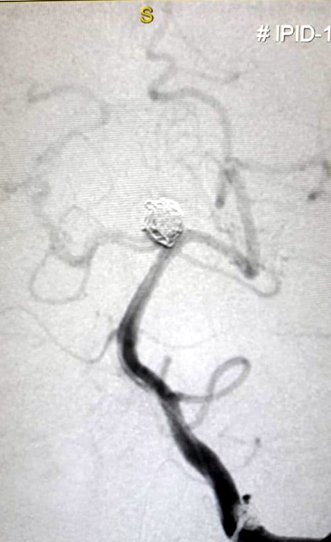 New technique to treat Aneurysm now at Ivy Hospital