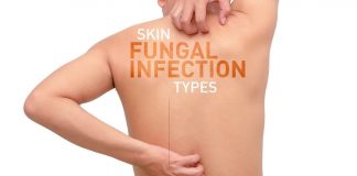 5 Causes and Symptoms of Skin Fungal Infections