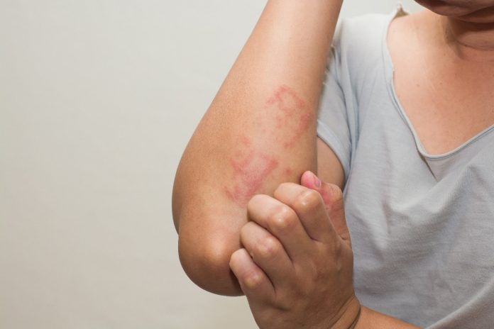 What is an Allergy test and its Types?