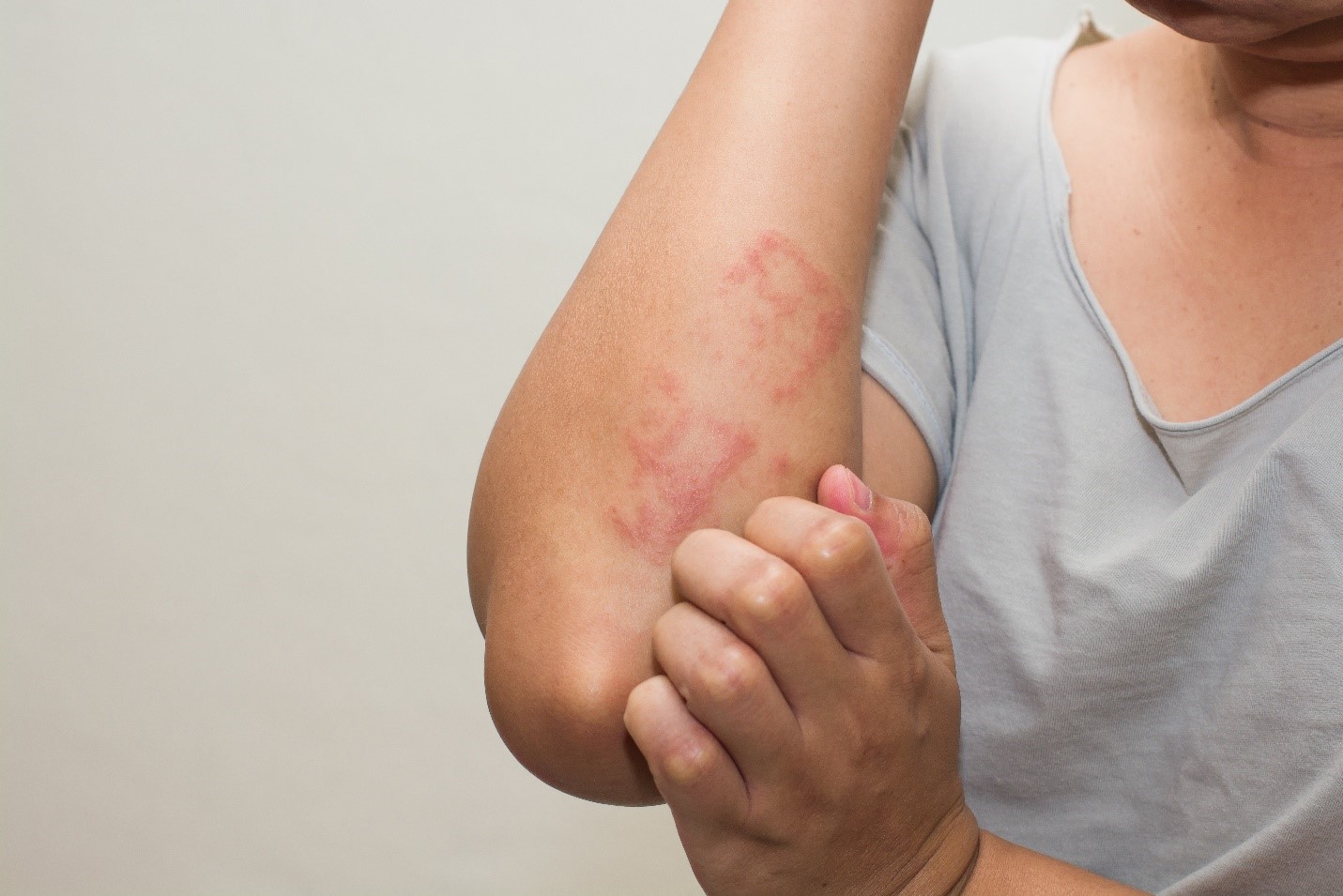 What is an Allergy test and its Types