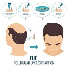 Get the Best FUE Hair Transplant in Jaipur at Rejuvena Cosmo Care