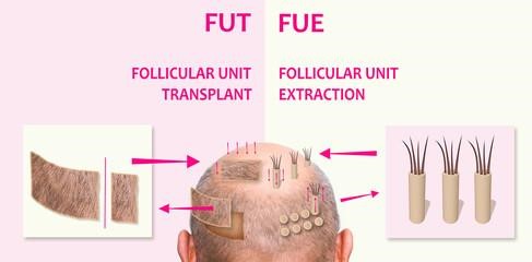 Best FUE Hair Transplant in Jaipur_2 - NewZNew Best FUE Hair Transplant in Jaipur_2 - NewZNew