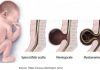 How is spina bifida in children associated with bladder and bowel
