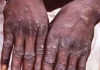 Canada confirms 16 monkeypox cases