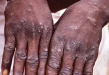 Canada confirms 16 monkeypox cases
