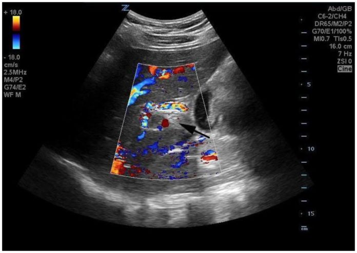Fortis Hospital Bannerghatta saves life of a Four-Year-Old suffering from Portal Vein Thrombosis